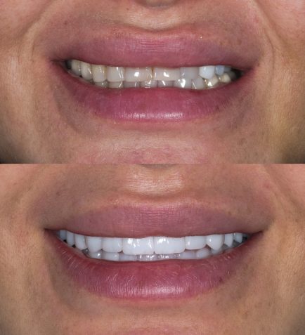 Before,And,After,Images,Displaying,The,Results,Of,Zirconium,Crown Before,And,After,Images,Displaying,The,Results,Of,Zirconium,Crown