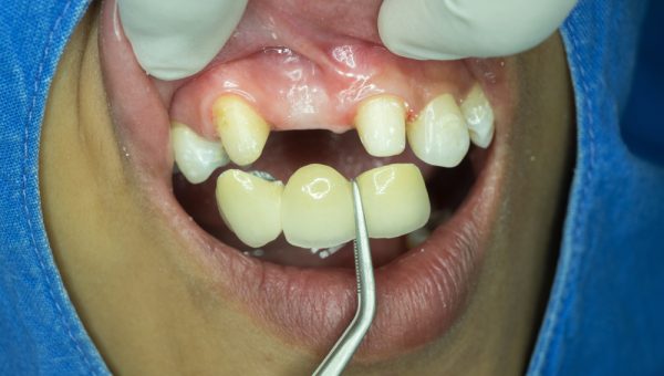 A,Dental,Bridge,Is,Preparing,To,Insert,In,Front,Teeth A,Dental,Bridge,Is,Preparing,To,Insert,In,Front,Teeth