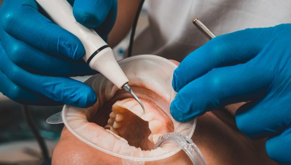 The,Dentist,Removes,Tartar,Using,Ultrasound,,The,Patient,At,The