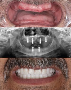 Full-arch,Dental,Implant-supported,Prostheses,For,A,Male,Patient,With,No Full-arch,Dental,Implant-supported,Prostheses,For,A,Male,Patient,With,No