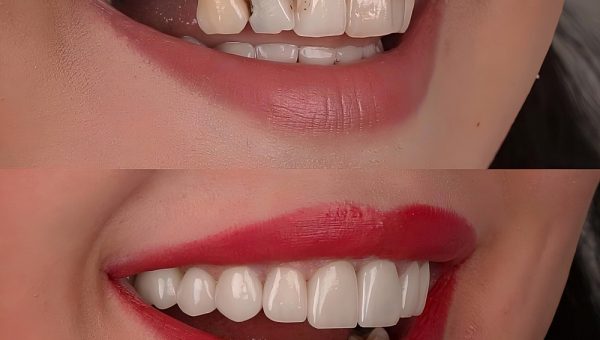 Smile,Design,Treatment,With,Dental,Porcelain,Veneers,In,Dentistry,,Smile Smile,Design,Treatment,With,Dental,Porcelain,Veneers,In,Dentistry,,Smile