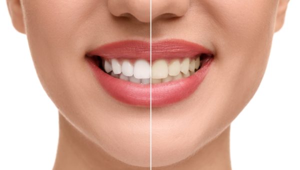 Woman,Showing,Teeth,Before,And,After,Whitening,On,White,Background,