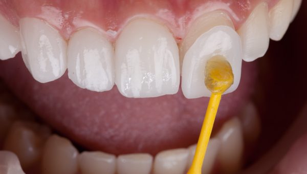 Dental,,Smile,Design,,White,Teeth Dental,,Smile,Design,,White,Teeth